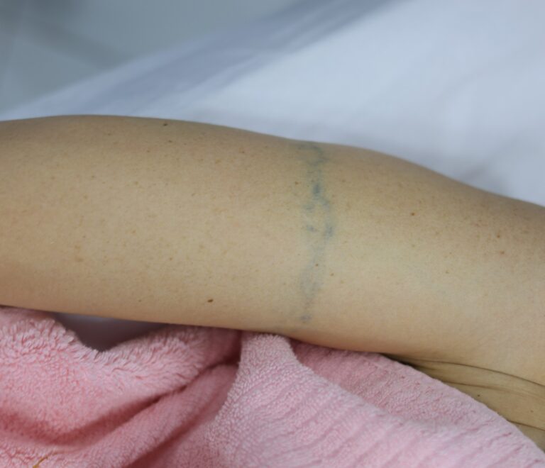 Îndepartarea cu laser a tatuajelor