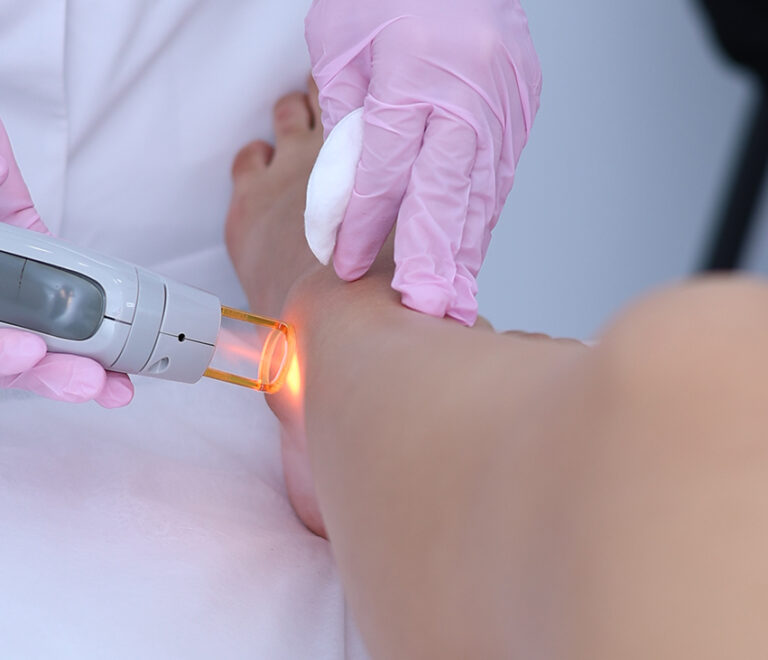 Tratamente cu laser pentru cicatrici