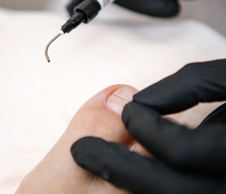 Tratamentul cu laser al micozei de unghie